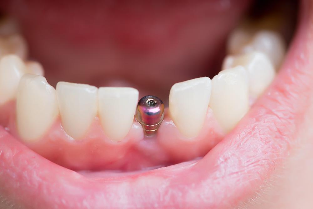 dental implant abutment