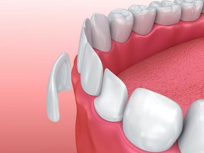 illustration of veneers being placed on bottom front teeth