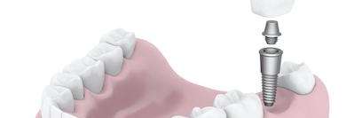 Dental implants in germantown